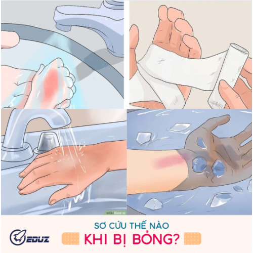 3 Phút Sơ Cứu - Bỏng